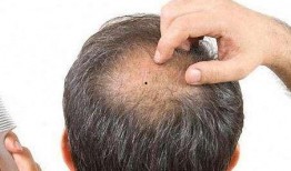 脂溢性脱发吃瓜补肾中药,中药调理脂溢性脱发新思路