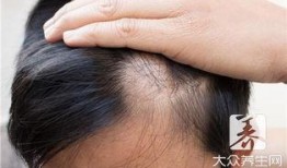 脂溢性脱发吃瓜补肾中药,中药调理脂溢性脱发新思路