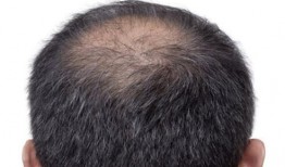 脂溢性脱发吃瓜补肾中药,中药调理脂溢性脱发新思路